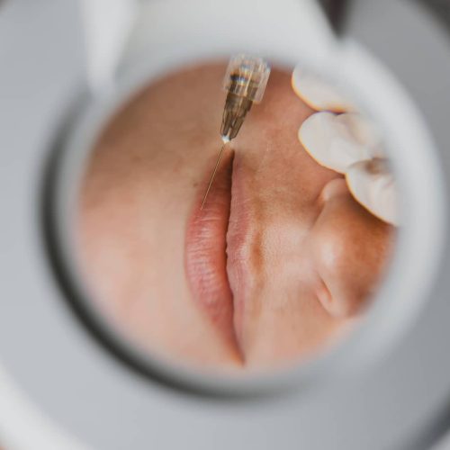 Lip fillers may cause allergies or, in some cases, acute medical problems due to the use of chemicals.