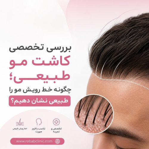 کاشت مو طبیعی (2)
